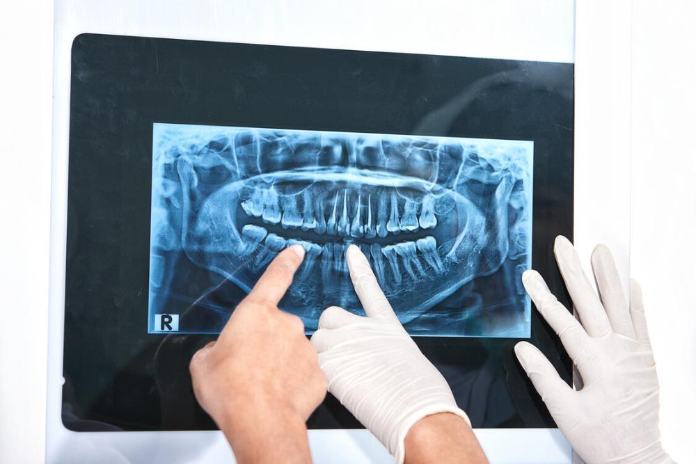 hands pointing at dental xray